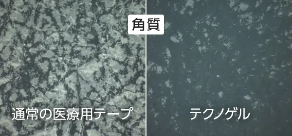 角質の比較。左：通常の医療用テープ/右：テクノゲル